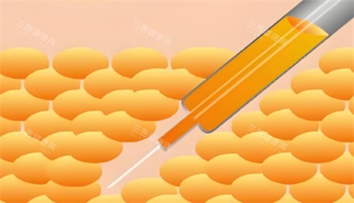 西安國醫(yī)整形籍建華怎么樣?吸脂+填充雙擅長,脂肪存活率高,全臉?biāo)苄纬匀唬?></div>
                <div   id=